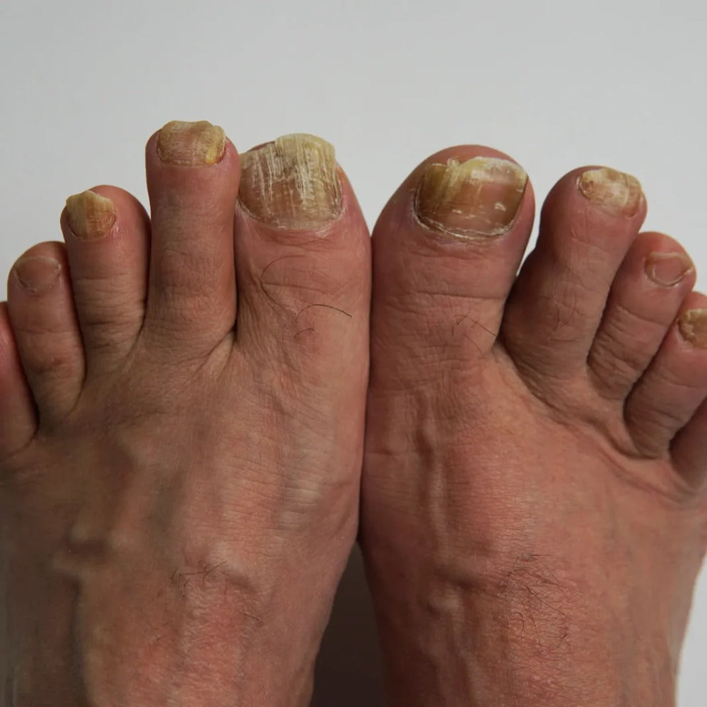 NailDerm Pro